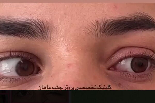 العين الصناعية المتحركة