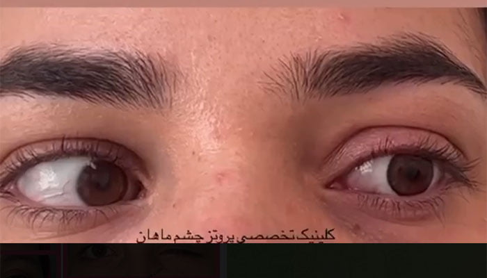 العين الصناعية المتحركة