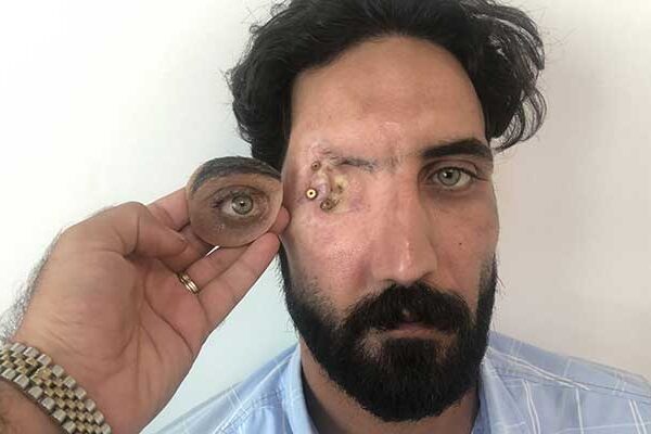 العين الاصطناعية المدارية