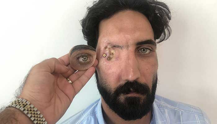 العين الاصطناعية المدارية