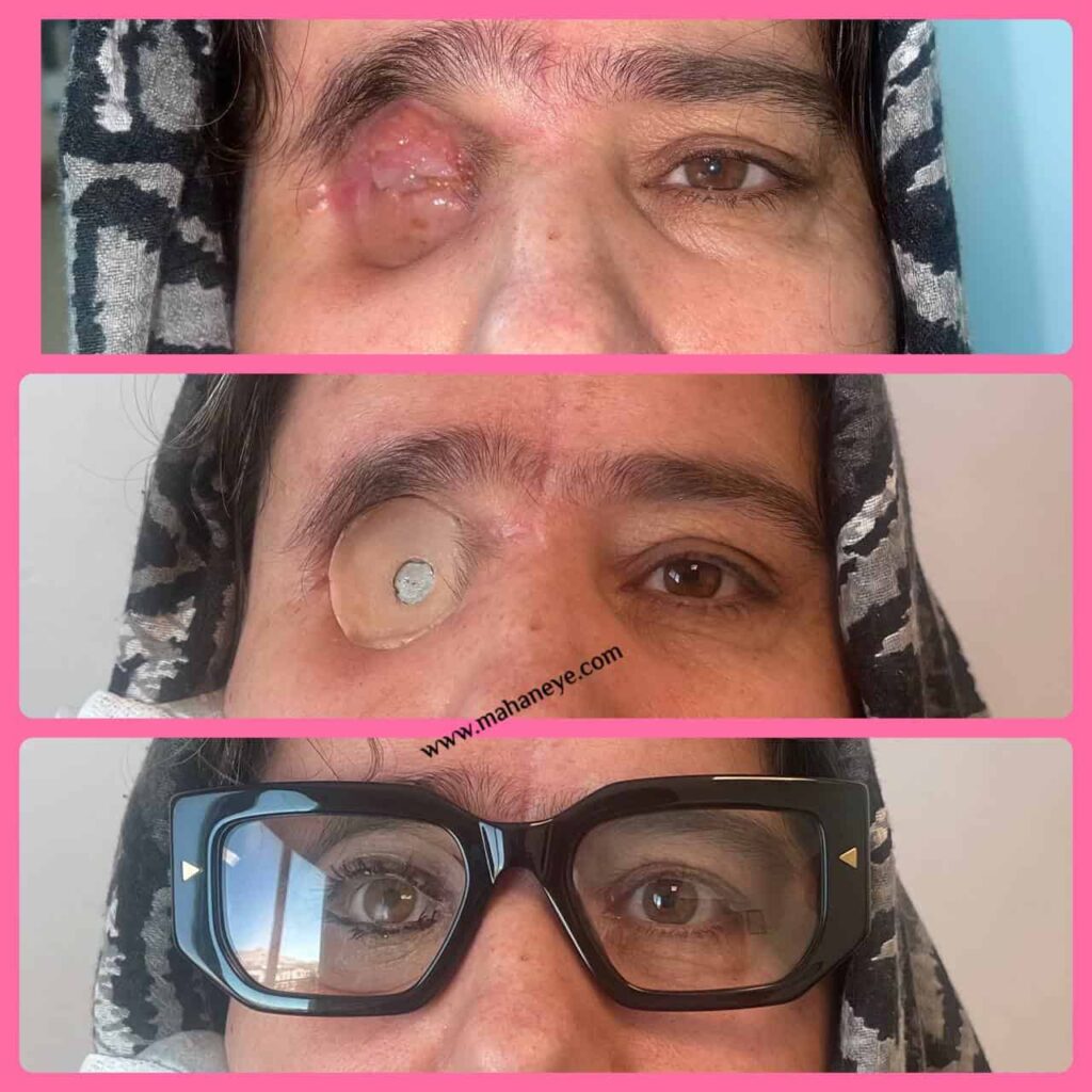 الصناعي المداري للعين