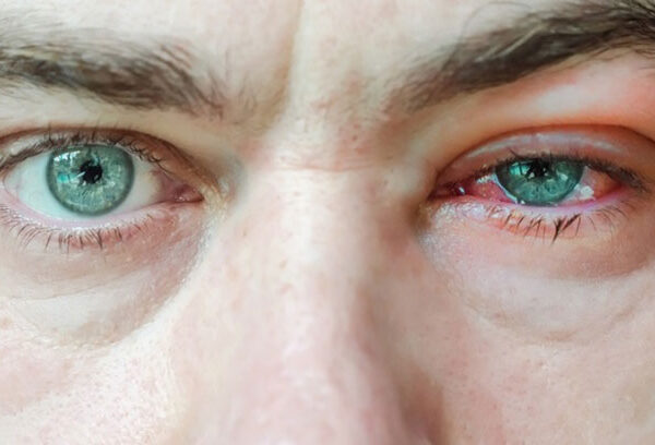 التهاب الجفن