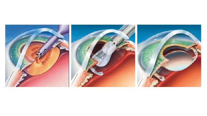طرق علاج الساد
