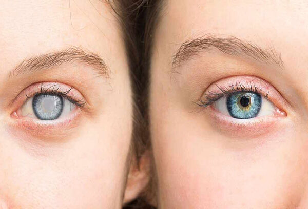 الساد (الماء الأبيض)