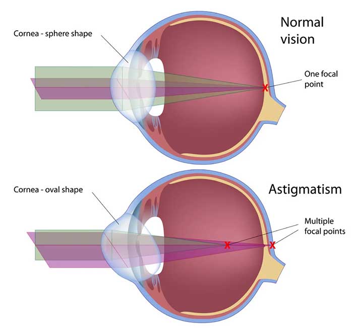 أخطاء الانكسار (Refractive Errors)