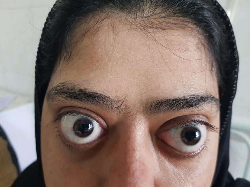 جحوظ العينين