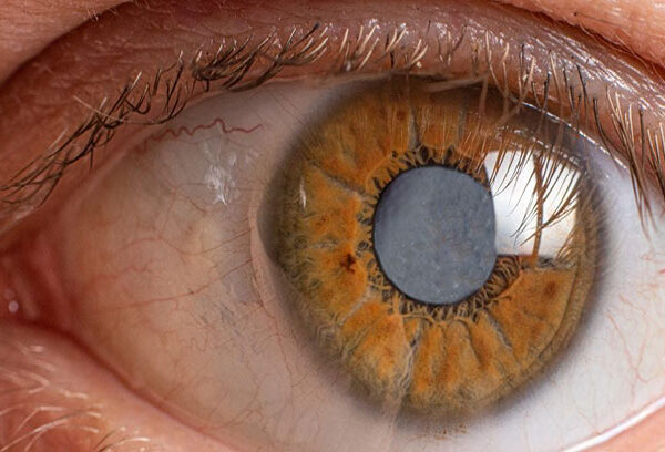 مرض الجلوكوما في العين