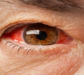 ارتفاع ضغط العين