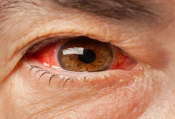 ارتفاع ضغط العين